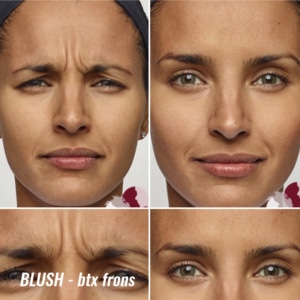 voor en na frons behandeling botox