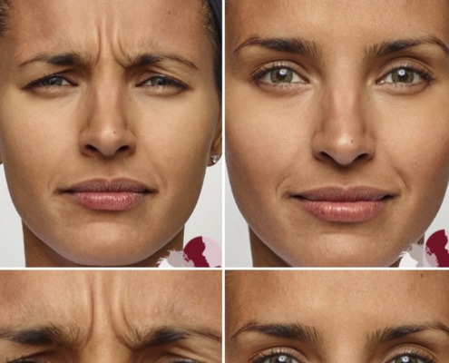 voor en na frons behandeling botox