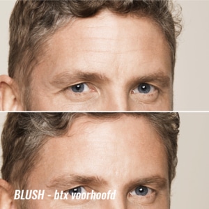 voor en na botox behandeling voorhoofdrimpels bij de man